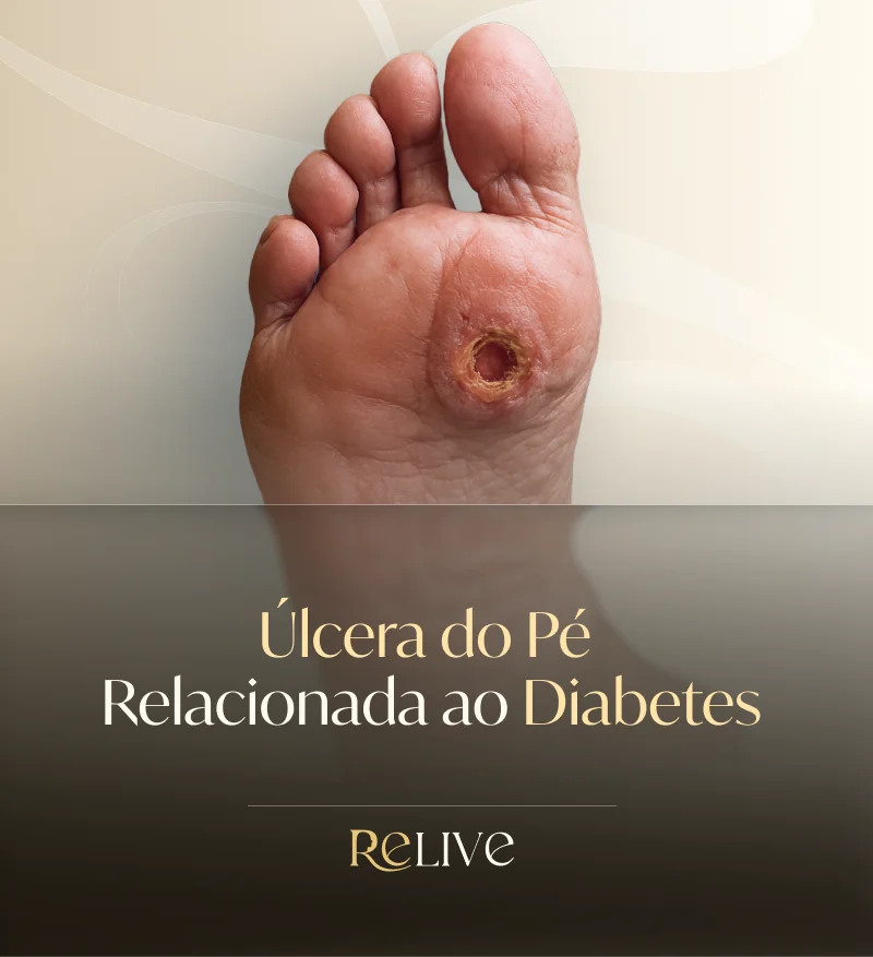 Úlcera de Pé Diabético