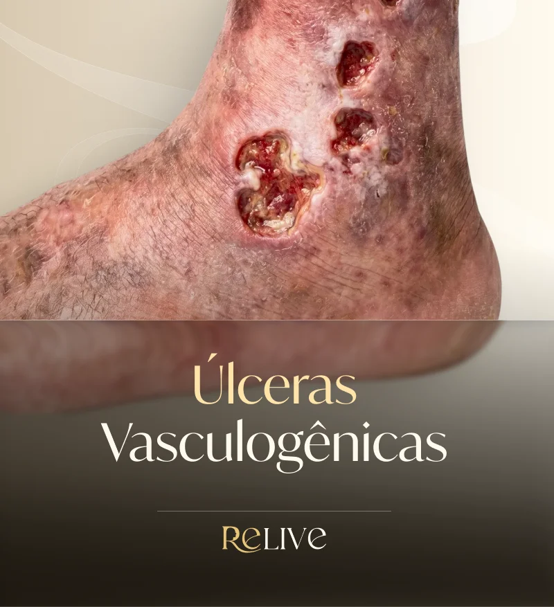 Úlceras Vasculogênicas