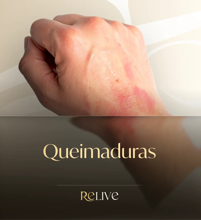 Queimaduras